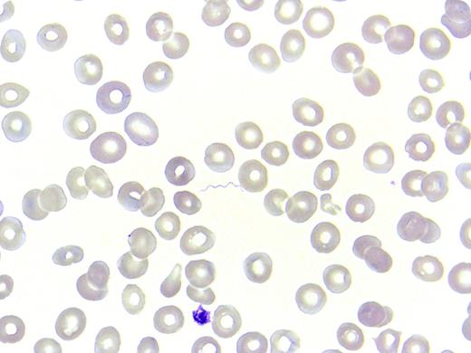 A 17-year-old refugee from Eritrea presented with sudden fever (to 41°C), myalgias, and headache. Three days before admission, he had arrived in Switzerland after a long journey through the Sudan and Libya and across the Mediterranean and Italy. Other than mild anemia, he had unremarkable blood values (hemoglobin, 122 g/L; white blood cells, 5.6 × 109/L; platelets, 187 × 109/L) and an increased C-reactive protein of 55 mg/L. No localizing infection was found by clinical examination, chest radiograph, or urine analysis. During a search for malaria, spirochetes were spotted in the blood film (Giemsa stained, original magnification ×100). Given the travel history and clinical symptoms, louse-borne relapsing fever (LBRF) was diagnosed, caused by Borrelia recurrentis. A treatment with doxycycline for 7 days was effective. / B recurrentis is transmitted by human body lice and is endemic in the highlands of eastern Africa, southern Sudan, and the Andean foothills. The disease occurs typically in overcrowded areas and in situations with reduced hygiene like war and mass migration. In recent months, an increasing number of cases have been reported in migrants to Europe. Wright- or Giemsa-stained blood smear during fever showing spirochetemia is considered diagnostic. Mortality in LBRF can be up to 5% even if treated. Treatment-induced Jarisch-Herxheimer reaction can occur.