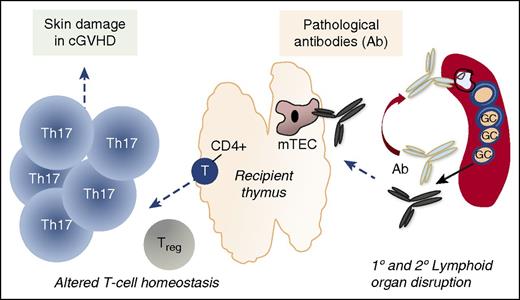 Working model of how donor-derived antibodies may help perpetuate cGVHD immune pathology. GCs are required for production of disease-inciting alloantibody early in the disease process. Due to altered T- and B-cell homeostasis, aberrant B cells develop over time that produce antibodies directed against primary (1°) and secondary (2°) lymphoid organs. Lymphoid-organ damage perpetuates loss of immune tolerance and the promotion of cGVHD of the skin. Treg, regulatory T cell.