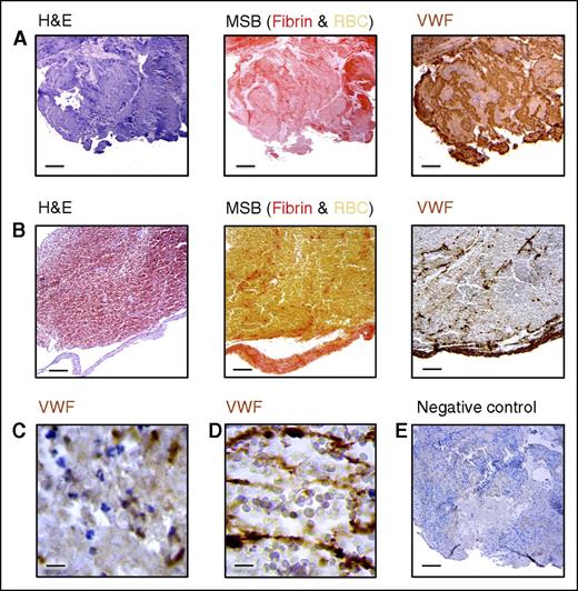 Figure 1. VWF staining on thrombi retrieved from stroke patients. Intracranial thrombi retrieved from stroke patients that underwent thrombectomy procedure were collected for histological analysis. Consecutive thrombi sections were stained with H&E, MSB, and anti-VWF antibodies. For the negative control, primary antibodies were omitted. Classical H&E staining was used to visualize overall thrombus composition and organization. On MSB staining, red areas show the presence of fibrin, whereas red blood cells (RBC) appear yellow. Interestingly, varying amounts of VWF (brown color) were found in all the thrombi analyzed. Two representative patient thrombi are shown illustrating a VWF-rich thrombus (A) and a red blood cell–rich, VWF-poor thrombus (B). Scale bar: 50 μm. (C) Higher magnification showing granular VWF staining. Scale bar: 5 μm. (D) A higher magnification of fibrillar/extracellular VWF. Scale bar: 5 μm. (E) Negative control for the anti-VWF staining. Scale bar: 50 μm.
