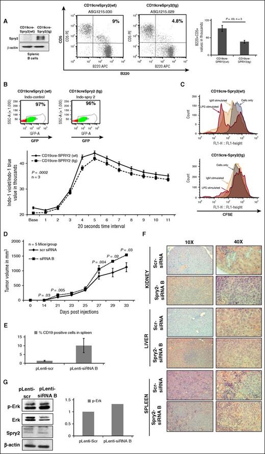 Figure 5. Effect of SPRY2 on B1-cell development, and BCR signaling in murine model and SPRY2 knockdown leads to disease progression in NSG mice. (A) Western blot showing overexpression of spry2 in splenic B cells of CD19-cre;Spry2(tg) mice (left). B1 cells were isolated from the peritoneal cavity of CD19-cre;Spry2(wt) and CD19-cre;Spry2(tg) mice. B1 cells were stained with CD5 and B220 dye to determine the frequency of B1 cells using flow cytometric analysis. Displayed is a dot plot showing B1a-cells frequency in CD19-cre;Spry2(wt) and CD19-cre;Spry2(tg) mice (middle). Bar graph of absolute number of B1a cells in the peritoneal cavity of CD19-cre;Spry2(wt) and CD19-cre;Spry2(tg) mice (right). (B) Splenic B cells were isolated by negative selection from rtTA-positive CD19-cre;Spry2(wt) (top, left) and CD19-cre;Spry2(tg) (top, right) mice. GFP+ population displays CD19-cre–expressed cells and displayed is calcium mobilization assay of splenic B cells from above described mice (bottom). n = 3; P = .0002. (C) Splenic B cells were isolated from CD19-cre;Spry2(wt) and CD19-cre;Spry2(tg) mice, stained with CFSE dye and cultured in vitro for 6 days with and without anti-IgM antibody and LPS. Displayed is the CFSE labeling of splenic B cells of CD19-cre;Spry2(wt) (top) and CD19-cre;Spry2(tg) (bottom) mice. SPRY2 was stably knocked down in Mec-1 CLL cells using pLenti-siRNA A and pLenti-siRNA B, and pLenti-scr was used as control. (D) Average of tumor volume in mice in each group were transplanted with 1.5 million pLenti-scr and pLenti-siRNA B Mec-1 CLL cells (n = 5). Tumor volume was measured using a digital caliper, and we determined the length and width of the tumor. Tumor volume was calculated by V = (L × W × W) / 2 where V is the tumor volume, L is the tumor length, and W is the tumor width. (E) Frequency of human CD19+ cells in spleen of pLenti-scr and pLenti-siRNA B CLL-cell–transplanted mice. (F) Hematoxylin and eosin staining with tissue section of kidney, liver, and spleen to observe the number of CLL-cell infiltration in pLenti-scr and pLenti-siRNA B CLL-cell–transplanted mice. (G) Protein lysates were prepared from tumors; equal amount of protein was loaded in each lane of 10% sodium dodecyl sulfate gel. Shown is scanned western blot to determine the protein levels of p-Erk and SPRY2 in tumors from pLenti-scr and pLenti-siRNA B CLL-cell–transplanted mice. Total Erk and β-actin were used as control. Densitometric measurements showing elevated p-Erk, normalized by total Erk in SPRY2 knockdown tumors. LPS, lipopolysaccharide; rtTA, reverse tetracycline transactivator; WT, wild-type.
