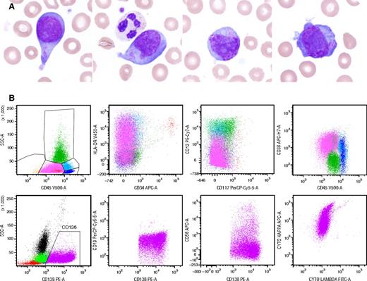 A 62-year-old man presented with headache, dysarthria, and a right subdural hematoma. Laboratory studies were remarkable for leukocytosis (white blood cells, 29.4 × 109/L), thrombocytopenia (platelets, 87 × 109/L), and anemia (hemoglobin, 7.8 g/dL) without rouleaux. Many abnormal cells (48%) with Auer rod–like inclusions were noted on peripheral blood smear (panel A). Initial flow cytometric studies revealed a prominent population positive for CD45 (dim), CD38, HLA-DR, and CD13 (partial), and negative for CD34, CD117, MPO, CD33, CD19, TdT, and CD3 (surface and cytoplasmic). Additional immunophenotyping to evaluate the CD38+CD34−CD117−CD3−CD19− “blast” population demonstrated plasmacytic lineage with expression of CD138, CD56 (subset), and cytoplasmic kappa light chain restriction (panel B). Approximately 93% kappa-restricted plasma cells were noted on the subsequent bone marrow evaluation, with a complex karyotype including hyperdiploidy and TP53 deletion. Subsequent studies showed an immunoglobulin G kappa serum and urine monoclonal paraprotein that persisted despite bortezomib/lenalidomide therapy. Lytic lesions also developed several months later. / Greater than 20% circulating plasma cells characterize plasma cell leukemia, an aggressive variant of plasma cell myeloma. Auer rod–like inclusions have been described in plasma cell neoplasms; however, they may be mistaken for evidence of myeloid differentiation when occurring in the context of an acute leukemia-like presentation. Comprehensive immunophenotyping is instrumental for accurate diagnosis.