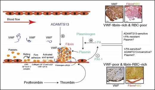 Potential roles of VWF in regulating the thrombolytic activity of t-PA. Results presented in this study are consistent with recent reports in linking VWF/ADAMTS13 to the pathogenesis of ischemic stroke. They suggest that VWF is involved in a subtype of ischemic stroke that has potentially more vascular injury. The VWF involvement may regulate t-PA efficacy and suggest alternative therapeutic targets. GP, glycoprotein; RBC, red blood cell. The histology images have been adapted from Figure 1 in the article by Denorme et al that begins on page 2337.