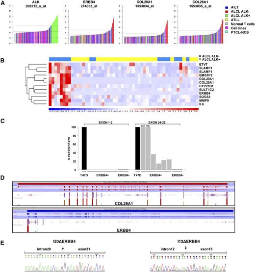 Figure 1. Identification of ERBB4 and COL29A1 as specific outliers in ALK-negative ALCL. (A) COPA of T-NHL microarray data revealed ERBB4 and COL29A1 as outlier genes in ALK-negative ALCL. ALK, ERBB4, and COL29A1 expression (normalized expression units) are shown from all profiled samples (data set from Agnelli et al11). Sample classes are indicated according to the color scale. Angioimmunoblastic lymphoma (AILT; 41 samples), ALK-negative ALCL (24 samples), ALK-positive ALCL (30 samples), normal T cells (69 samples), PTCL-NOS (74 samples); adult T-cell leukemia/lymphoma (ATLL; 11 samples), cell lines (4 samples). (B) Hierarchical clustering of transcripts correlated to ERBB4 expression in ALCL samples (ALK-positive, yellow; ALK-negative, blue), as revealed by the average linkage method using Euclidean distance. Each column represents a sample, and each row a gene. The color scale bar represents relative gene expression changes, normalized by the standard deviation. Microarray data analysis was performed as described in Piva et al15. (C) Unbalanced expression of ERBB4 transcripts. Expression of ERBB4 (exons 1-2 and 24-25) was assessed by qRT-PCR in 8 ALCL cases and in the breast cancer cell line T47D, used as a positive control. (D) Distribution of ERBB4 and COL29A1 RNA sequencing reads in a representative ERBB4-positive ALCL case. (E) Electropherograms of 2 ERBB4-truncated transcripts: I20Δ (exon 21 carrying at 5′ a portion of intron 20 (GRCh37:2:212329687:212330078) and I12Δ (exon 13 carrying at 5′ a portion of intron 12 (GRCh37:2:212558507:212558780). Fragments were identified by RLM-RACE in a representative ERBB4-positive ALCL case. Arrows point to the position of intron-exon junctions.