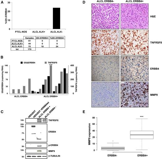 Figure 2. Expression and incidence of ERBB4-truncated transcripts. (A) Incidence of I20ΔERBB4 expression analyzed by qRT-PCR in a total (tot) of 170 cryopreserved and formalin-fixed and paraffin-embedded T-NHL samples (51 PCTL-NOS, 44 ALK-positive ALCL, and 75 ALK-negative ALCL). (B) Quantification of I20ΔERBB4 and TNFRSF8 transcripts by ddPCR assay in selected ALCL cases. (C) Western blot analysis of the HEK293T cell line transfected with wild-type (wt) ERBB4 and 2 ALCL samples (1 ERBB4-positive and 1 ERBB4-negative). Tissue lysates from an ERBB4-positive sample indicated the expression of a 50-kDa truncated ERBB4 protein, which was highly phosphorylated and correlated to MMP9 expression. (D) Representative hematoxylin and eosin (H&E), TNFRSF8, ERBB4, and MMP9 immunohistochemical staining in an ERBB4-negative and an ERBB4-positive ALCL sample (original magnification ×20). (E) Box plot showing immunohistochemical quantification of MMP9 expression in ALK-negative ALCL patients (8 ERBB4-negative and 7 ERB-positive). Quantitative analysis indicates percentage of anaplastic cells with a score of 3+. Measurements were performed in 3 independent tissue areas (***P < .001). MMP9, matrix metalloproteinase 9; TNFRSF8, tumor necrosis factor receptor superfamily, member 8.
