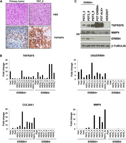 Figure 6. ERBB4-positive PDT phenocopies the tumor of origin. (A) Hematoxylin and eosin (H&E) and TNFRSF8 stainings of primary tumor and PDT, passage 8. (B) Expression of TNFRSF8, I20ΔERBB4, COL29A1, and MMP9 transcripts as assessed by qRT-PCR in primary tumors (Pat) and PDTs. PDTs have the same number of patient-of-origin numbers after underscores, indicating the in vivo passages. (C) Western blot analysis of PDT lysates confirmed the expression of TNFRSF8, MMP9, and ERBB4. NS*, nonspecific band.