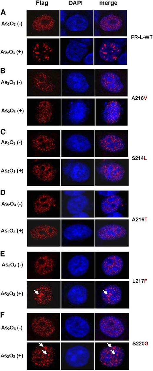 Figure 3. Varying cellular localization of mutant PML-RARA upon As2O3 treatment compared with wild-type. Representative immunofluorescence analysis for Flag-tagged wild-type (A) and mutant (B-F) PML-RARA expressed in HeLa cells, with or without As2O3 treatment (1 μM, 16 hours). The staining of Flag is shown in red. 4,6 diamidino-2-phenylindole (DAPI) is shown in blue.
