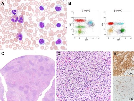A 25-year-old woman presented with diffuse “lumps” under the skin and was found to have peripheral eosinophilia and an atypical circulating lymphocyte population (white blood cells, 10.8 × 109/L; 22% lymphocytes; and 12% eosinophils) (panel A). No history of atopy was noted. Peripheral blood (PB) flow cytometry demonstrated an abnormal T-cell population with loss of surface CD3; expression of CD2, CD5, CD4; and loss of CD7 (panel B). Biopsy of one of the lesions on the chest wall revealed a paracortical infiltrate of small, atypical lymphocytes with irregular nuclei and pale cytoplasm, admixed with eosinophils (panels C-D). The immunophenotype of these lymphocytes matched the atypical T cells in the PB (panel E) (cytoplasmic CD3 is positive by immunohistochemistry) and additionally lacked staining for TFH markers CD279 and CD10. T-cell receptor gene rearrangement analysis revealed a clonal rearrangement. / The findings in this case are typical for the lymphocytic variant of hypereosinophilic syndrome, which is now regarded as a T-cell lymphoproliferative disorder characterized by eosinophilia and sCD3-negative T cells in the blood. Although rare, the lymphocytic variant of hypereosinophilic syndrome is in the differential diagnosis for a patient with isolated eosinophilia and highlights the need for PB flow cytometry to evaluate this atypical T-cell population. Recently, involvement of lymph nodes and other tissue sites has been recognized and could easily be mistaken for peripheral T-cell lymphoma and treated aggressively without the appropriate clinical history.