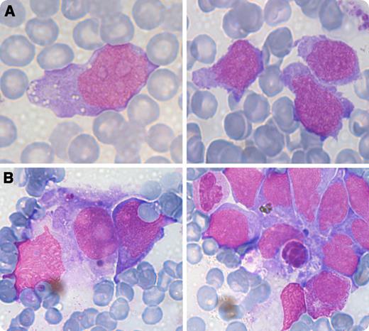 A 12-year-old child, without a significant medical history, presented with abdominal discomfort. Physical examination revealed marked hepatosplenomegaly. Blood tests showed anemia (7.4 g/dL), thrombocytopenia (107 × 109/L), and a normal white blood cell count (9.5 × 109/L). Rare atypical cells (<1%) were seen in the peripheral blood smear. Bone marrow aspirate (May-Grünwald-Giemsa stained) was invaded by tumor cells (67%), medium to large in size, with pale basophilic ungranulated cytoplasm, round nuclei with dispersed nuclear chromatin (panel A), and erythrophagocytosis (panel B). These large blastlike cells suggested lymphoblastic leukemia. Flow cytometry immunophenotyping revealed the following T-lineage profile: CD2+sCD3+CD4−CD5−CD7+CD8−TCRγδ+. Cells did not express immature markers (CD34−CD117−) or markers for others lineages. Karyotype showed isochromosome 7q, trisomy 8, and loss of chromosome Y. Despite the blast-like appearance, absence of CD5 associated with sCD3 and TCRγδ positivity excluded the diagnosis of T-lymphoblastic leukemia. Although isochromosome 7q and trisomy 8 are known cytogenetic abnormalities in a number of hematologic malignancies, the combination of both is unique in hepatosplenic T-cell lymphoma (HSTL). Moreover, erythrophagocytosis is a reported finding in HSTL. / This is an unusual case of HSTL presenting in a very young patient with a blastic phase at the time of diagnosis. Despite the use of a high-risk protocol, no remission was obtained, and the patient died 6 months after diagnosis.