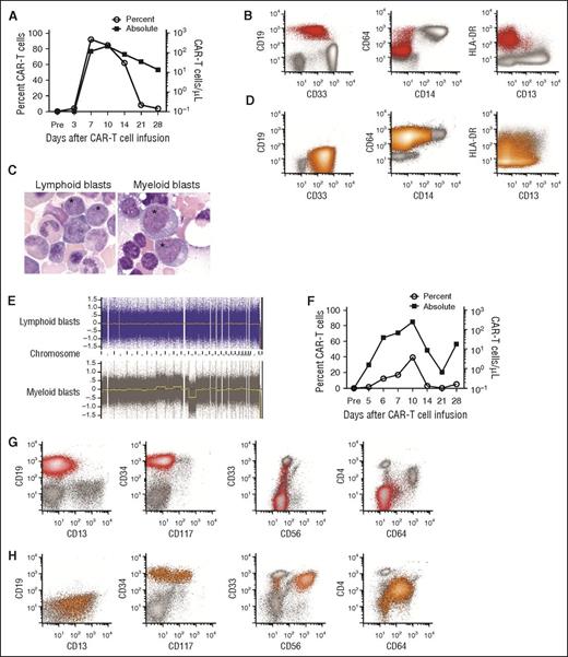 Figure 1. Emergence of CD19−myeloid phenotype blasts after effective CD19 CAR-T-cell therapy for CD19+ MLL-rearranged B-ALL. (A-E) Data from the patient in case 1. (F-H) Data from the patient in case 2. (A) The percentage of CD19-specific CAR-T cells in CD3+ T cells (open circles) and the absolute CAR-T-cell count (squares) in blood on the indicated days after CAR-T cell infusion are shown for patient 1. CAR-T cells were identified as viable CD45+/CD3+/epidermal growth factor receptor-positive events in a lymphoid forward scatter/side scatter gate by flow cytometry, and the absolute count was determined by multiplying the absolute lymphocyte count by the percentage of CAR-T cells in a lymphoid gate. (B) Flow cytometry of peripheral blood demonstrating CD19+ lymphoblasts (red) before CAR-T-cell therapy. The blasts expressed a low level of CD33 and were largely CD64−, CD14−, and CD4− (not shown). Flow plots are gated on mononuclear cells. (C) The abnormal blasts (*) before CAR-T-cell therapy were morphologically distinct from the abnormal blasts after CAR-T-cell therapy. (D) Flow cytometry of peripheral blood obtained on day 35 after CAR-T-cell infusion showing abnormal blasts (orange) without expression of CD19, CD20, CD22, CD24, or cytoplasmic CD79a (not shown). The abnormal blasts were CD33hi, CD64+, and CD4+ (not shown), and CD14− and CD34− (not shown), consistent with AML with monocytic differentiation. (E) CGAT identified multiple genomic aberrations in the monoblasts isolated after CAR-T-cell infusion, which were not present in the CD19+ lymphoblasts isolated before CAR-T-cell infusion. (F) The percentage of CD19-specific CAR-T cells in CD3+ T cells (open circles) and the absolute CAR-T-cell count (squares) in blood on the indicated days after CAR-T-cell infusion are shown for patient 2. (G) All plots show mononuclear cells. Flow cytometry of bone marrow before CAR-T-cell therapy demonstrating CD19+ abnormal lymphoblasts (red). At diagnosis, the patient’s abnormal blasts also expressed CD34, CD22 (not shown) without CD4, CD10 (not shown), CD13, significant CD33, CD56, CD64, or CD117. (H) Flow cytometry of bone marrow on day 30 after CAR-T-cell infusion, showing no abnormal CD19+ blasts or normal B-cell precursors, but abnormal myeloblasts (orange) that express CD34 with CD4, CD13, bright CD33, CD64 (intermediate), and CD117 (subset), with aberrant expression of CD56 on a major subset.