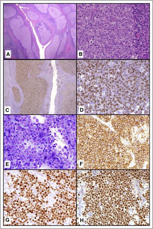 Figure 1. New provisional B-cell lymphoma entities. (A-D) LBCL with IRF4 rearrangement. (A) Note the very large abnormal-appearing follicles in the central portion of this tonsil. (B) The neoplastic follicles have numerous transformed cells that are (C) IRF4/MUM-1+ and (D) BCL6+. (E-H) Burkitt-like lymphoma with 11q aberration. (E) The touch imprint demonstrates a monotonous population of transformed cells with basophilic cytoplasm that are (F) CD20+, (G) have a very high MIB1/Ki-67 proliferation fraction, and are (H) BCL6+. (A-B) Hematoxylin and eosin stain; (C,D-H) immunoperoxidase stains as specified; (E) Romanowsky-type stain.