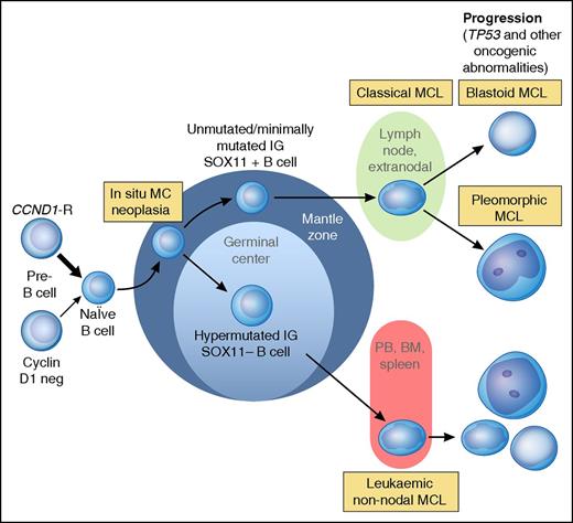 Figure 2. Proposed model of molecular pathogenesis in the development and progression of major subtypes of MCL. Precursor B cells usually with but sometimes without a CCND1 rearrangement mature to abnormal naïve B cells which may initially colonize, often the inner portion of the mantle zones, representing ISMCN. These cells already have additional molecular genetic abnormalities, such as inactivating ATM mutations. They may progress to classical MCL which most frequently is SOX11+, has no evidence of transit through the germinal center, and is genetically unstable acquiring additional abnormalities related to cell cycle dysregulation, the DNA damage response pathway, cell survival, and other pathways. Ultimately, progression to blastoid or pleomorphic MCL may occur. A smaller proportion of neoplastic mantle cells may undergo somatic hypermutation, presumably in germinal centers, leading to SOX11− MCL that are more genetically stable for long periods of time and which preferentially involve the PB, bone marrow (BM), and sometimes the spleen. Even these MCL, however, may undergo additional molecular/cytogenetic abnormalities, particularly TP53 abnormalities, leading to clinical and sometime morphological progression. Adapted from Jares et al31 and Swerdlow et al.2 Professional illustration by Patrick Lane, ScEYEnce Studios.