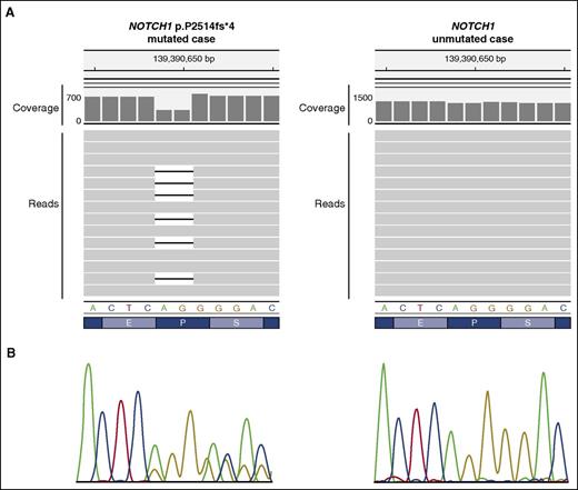 Figure 3. NOTCH1 mutation detected by NGS and Sanger sequencing. (A) NOTCH1 p.P2514fs*4 (NP_060087.3) (c.7541-7542delCT, NM_017617.3) mutation detected by NGS (MiSeq, Illumina) as visualized in the Integrative Genomics Viewer (IGV, www.broadinstitute.org/igv, human reference genome GRCh37/hg19) (left, mutated case) and the same region of a NOTCH1 unmutated sample (right, unmutated case). In each case, the nucleotide coverage as well as a few representative NGS reads are shown. A deletion of AG (CT if considering the reverse strand) is observed in the mutated case. By NGS, each read is represented by a gray horizontal bar and the deletion is represented as a black line within those reads carrying the mutation. A decrease in 50% of the coverage can be observed for the 2 nucleotides affected showing that the mutation is present in half of the reads. (B) Sanger sequencing results are shown under the reference nucleotide and amino acid sequences.