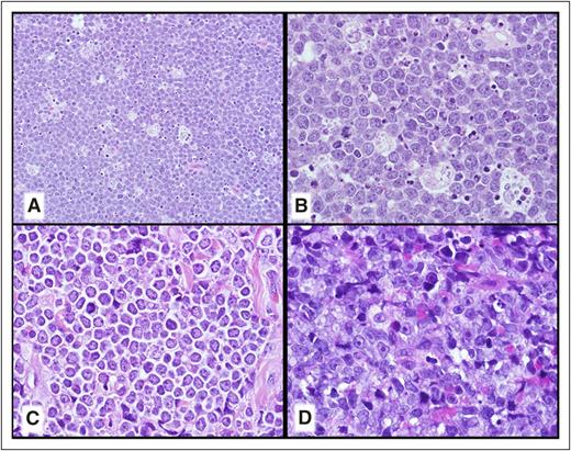 Figure 5. Cytologic spectrum of HGBL, with MYC and BCL2 and/or BCL6 rearrangements. (A-B) This HGBL with MYC and BCL6 rearrangements closely resembles a BL including a starry sky with tingible body macrophages and many intermediate-sized transformed cells although there are some subtle cytologic differences from a classic BL. (C) This HGBL with MYC, BCL2, and BCL6 rearrangements appears more blastoid but was TdT−. (D) This HGBL with MYC and BCL2 rearrangements would otherwise have been considered a DLBCL that included many immunoblastic-type cells with single prominent central nucleoli. (A-D) Hematoxylin and eosin stain.