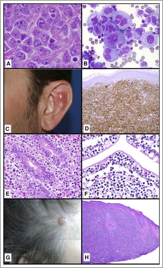 Figure 6. TCLs. (A) ALK− ALCL with DUSP22 rearrangement. There is a relatively monotonous proliferation of large transformed cells and classic “Hallmark” cells. (B) Breast implant–associated ALCL. The seroma cavity demonstrates numerous very large anaplastic-appearing lymphoid cells. (C-D) Primary cutaneous acral CD8+ TCL. (C) Nodule on the ear. (D) There is a diffuse monotonous infiltrate of CD8+ T cells. (E) EATL. The somewhat pleomorphic intestinal infiltrate extends into the epithelium and would be associated with enteropathic changes elsewhere in the intestine. (F) MEITL. The monotonous intestinal infiltrate is very epitheliotropic. (G-H) Primary cutaneous CD4+ small/medium T-cell LPD. (G) Small nodule on scalp. (H) Although the infiltrate is dense and lymphoma-like, this is now to be considered a lymphoproliferative disorder rather than a “lymphoma.” (A,E,F,H) Hematoxylin and eosin stain; (B) Romanowsky-type stain; (D) CD8 immunoperoxidase stain.