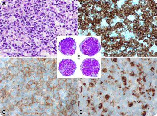 A 78-year-old white American man presented with fever, jaundice, and respiratory distress. Laboratory tests showed the following: white blood cells 4.2 (4-11) × 109/L, hemoglobin 11.7 (13.1-17.2) g/dL, platelets 21 (140-440) × 109/L, bilirubin 9.2 (0.2-1.2) mg/dL, aspartate aminotransferase 1345 (10-37) U/L, alanine aminotransferase 599 (5-40) U/L, alkaline phosphatase 313 (40-125) U/L, lactate dehydrogenase 2102 (98-192) U/L, international normalized ratio 2.4 (0.89-1.29), activated partial thromboplastin time 149 (22-36) seconds, haptoglobin <20 (30-200) mg/dL, and fibrinogen 56 (200-425) mg/dL. A chest–computed tomography scan revealed pulmonary infiltrates and mediastinal lymphadenopathy. Subcarinal lymph node biopsy showed numerous small-to-medium neoplastic cells (panel A) that expressed CD2, cCD3 (panel B), CD7, CD30, CD56 (panel C), TIA1, granzyme B, perforin, and Epstein-Barr virus (EBV; panel D) and were negative for CD4, CD5, and CD8. The Ki67 proliferation index on this specimen showed 90% nuclear staining. Peripheral blood flow cytometry showed 17% abnormal natural killer cells (panel E) expressing CD2, CD7dim, TIA1, and CD56dim and was negative for sCD3 and terminal deoxynucleotidyl transferase. A diagnosis of EBV-associated aggressive natural killer cell leukemia (ANKL) was established. The patient deteriorated rapidly and died. / ANKL is a rare, aggressive, EBV-associated leukemia primarily affecting young Asians. B symptoms, organomegaly, hemophagocytosis, and disseminated intravascular coagulation are common. Complex cytogenetic abnormalities are relatively frequent, and clonal T-cell receptor gene rearrangements are absent. ANKL has been reported in fewer than 20 patients of white Western European descent.