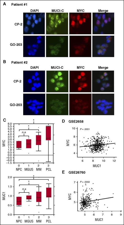 Figure 6. Correlation between MUC1 and MYC expression in primary MM cells. (A-B) Primary CD138+ MM cells obtained from patient 1 (A) and patient 2 (B) were stained for MUC1-C (green) and MYC (red) expression. DAPI counterstain was used to visualize nuclei. Immunofluorescence images were obtained using a Nikon Ti inverted microscope at a magnification of ×20. (C) Microarray data from Oncomine database are expressed as box plots (25th-75th percentiles) for MYC (top panels) and MUC1 (bottom panels) expression in NPCs (n = 5), MGUS (n = 11), MM (n = 133), and PCL (n = 9). The data were log2 transformed and median centered (dark lines). *P value of <.05. (D-E) Microarray gene expression data from GEO data sets GSE2658 (D; n = 559) and GSE26760 (E; n = 304) was robust multiarray average normalized and the correlation between MUC1 and MYC expression in MM patients was assessed by the Spearman rank-order correlation, where P < .05 was considered as statistically significant. n.s., not significant.