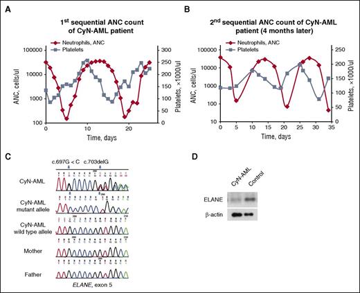 Figure 1. Patient characteristics associated with neutropenia. (A-B) Representative patterns of neutrophil (blue line) and platelet (orange line) cycling in the CyN-AML patient during G-CSF treatment. ANCs and platelet counts were plotted for 25 days (left) and for 35 days (right), accordingly. (C) Genetic characterization of double de novo ELANE mutations in the CyN-AML patient. The blue arrows above the Sanger sequencing traces indicate the positions of the mutations. Cloning of a genomic DNA fragment spanning ELANE c.697G<C and c.703delG showed that both mutations were present on the same allele. Two representative examples of sequenced clones are shown. Sequencing of ELANE exon 5 revealed no ELANE mutations in parental DNA isolated from peripheral blood MNCs. (D) Western blot analysis of ELANE protein expression in BM polymorphonuclear cells of the CyN-AML patient and healthy donors. β-actin was used as a loading control. The level of ELANE protein expression was lower in BM polymorphonuclear cells of the CyN-AML patient as compared with healthy donors. The blot shown is representative of 3 independent experiments. BM, bone marrow; MNC, mononuclear cell.