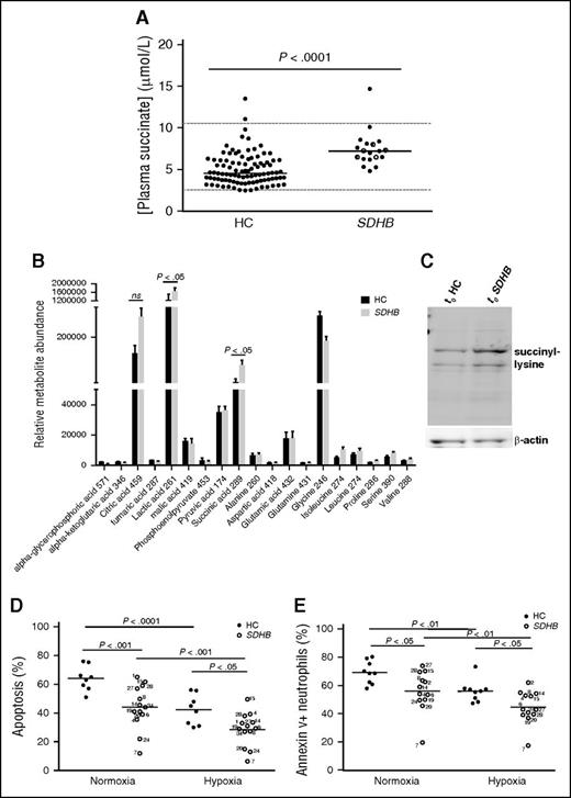 Figure 1. Heterozygous SDHB neutrophils display a specific metabolic signature and enhanced survival. (A) Plasma succinate concentrations were determined for 97 healthy controls (HC) and 19 patients with germ line mutations in SDHB. Filled, half-filled, and open circles represent patients without, with previous, and with current tumors, respectively. Solid lines represent median values, and dashed lines represent upper and lower limits of reference. (B-E) Human peripheral blood neutrophils from healthy controls (HC) and SDHBx patients were studied in parallel. (B) Relative metabolite abundance. Freshly isolated neutrophils were lysed in methanol, the liquid phase was subjected to gas chromatography–mass spectrometry, and relative quantification of 20 key metabolic intermediaries was performed. Data represent mean ± SEM, n = 3. (C) Succinylation. Freshly isolated neutrophil lysates were separated by SDS-PAGE, and membranes were probed for succinylated protein expression relative to β-actin control; blot is representative of n = 3. (D-E) Apoptosis. Neutrophils were cultured for 20 hours in normoxia or hypoxia, and apoptosis was determined by morphology (D) and flow cytometry (Annexin V) (E). Solid bars represent mean; P values were determined by Mann-Whitney U test (A), unpaired Student t test (B), or 2-way ANOVA (D-E). ANOVA, analysis of variance; PAGE, polyacrylamide gel electrophoresis; SDS, sodium dodecyl sulfate; SEM, standard error of the mean.