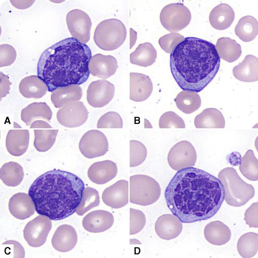 A 73-year-old man presented with fatigue and dyspnea and was found to have pancytopenia. His complete blood count showed hemoglobin of 81 g/L, mean corpuscular volume of 96 fL, platelet count of 28 × 109/L, white blood cell count of 12.4 × 109/L, with neutrophils of 1.0 × 109/L. He previously had mild macrocytic anemia (since 2008). He had mild splenomegaly with no lymphadenopathy. His peripheral blood smear revealed frequent mononuclear atypical cells lacking prominent nucleoli with abnormal nuclear chromatin clumping (large blocks of chromatin separated by clear zones) that the CellaVision DM96 system misclassified as promyelocytes (panels A-B), myelocytes (panel C), and monocytes (panel D). The bone marrow examination revealed acute myeloid leukemia with myelodysplasia-related changes, with marked chromatin clumping in the CD34+ cells. Flow cytometry confirmed dimCD45/CD34/CD117/CD13/CD33/HLA-Dr positive myeloid blasts (71%) heterogeneously coexpressing CD7 and CD11b. Cytogenetic studies revealed monosomy 20 and inversion 7. / Abnormal chromatin clumping in cells of myeloid lineage has been described in myelodysplasia, BCR-ABL1 negative atypical chronic myelogenous leukemia, drug effect with mycophenolate mofetil, and acute leukemia with trilineage dysplasia. In our patient, an abnormal nuclear chromatin pattern altered the appearance of myeloblasts in the peripheral blood, creating a more “condensed” chromatin appearance that mimicked chronic lymphocytic leukemia, peripheralized lymphoma, or chronic myelomonocytic leukemia.