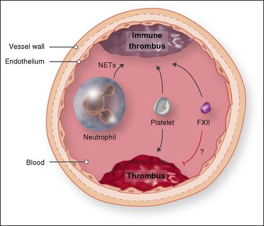 Comparison of two mouse models of venous thrombosis. In the inferior vena cava stenosis model of venous thrombosis, the inferior vena cava is ligated to reduce blood flow by ∼90%. Platelets, FXII, and neutrophils contribute to immune thrombosis. In the spontaneous venous thrombosis model, mice are treated with small interfering RNAs to reduce levels of the anticoagulants antithrombin and protein C. Platelets contribute to thrombosis in this model, whereas there is no role for neutrophils, and decreasing FXII increases thrombosis. NET, neutrophil extracellular trap. Professional illustration by Somersault18:24.