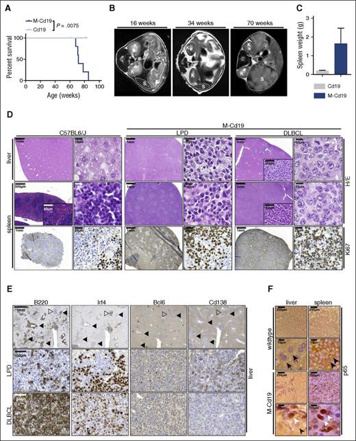 Figure 2. B-cell–specific Myd88p.L252P expression drives lymphoproliferation and lymphomagenesis in vivo. (A) B-cell–specific expression of Myd88p.L252P significantly reduces overall survival in vivo. Kaplan-Meier curves illustrate the overall survival of M-Cd19 mice. M-Cd19 mice display a significantly reduced survival compared with the respective controls (log-rank test). (B) Serial MRI scans in 16-, 34-, and 70-week-old M-Cd19 mice revealed the occurrence of splenomegaly in 70-week-old M-Cd19 mice. (C) M-Cd19 mice display splenomegaly at the time of death. Preterminal M-Cd19 and Cd19 mice were sacrificed and spleen weight was recorded. Bars represent the average (n = 3); error bars represent standard deviations. (D) M-Cd19 mice develop lymphoproliferative disease and occasional lymphoma. The top panels show H&E staining of spleens and livers isolated from C57BL/6 and M-Cd19 mice at the time of death. Although the organ architecture appeared normal in C57BL/6 wild-type mice, the architecture of spleens isolated from M-Cd19 mice was largely disrupted by infiltration of small mature lymphocytes (LPD columns) or large blastoid cells (DLBCL columns). The bottom panel shows the partial and complete disruption of the spleen by infiltrates with high proliferative indices. (E) Immunohistochemical characterization of the liver infiltrates of M-Cd19 mice. Areas of infiltrates morphologically resembling DLBCL (marked with solid triangles) showed a homogeneous staining pattern of B220 and Irf4 positivity, whereas they were negative for Bcl6 and Cd138 (bottom panel). Infiltrated areas of small, mature lymphocytes (marked with open triangles) displayed a more heterogeneous staining pattern of positive and negative cells for B220, Irf4, and Cd138, whereas staining was largely negative for Bcl6 (middle panel). (F) The lymphoma cells infiltrating spleens and livers of M-Cd19 mice displayed a largely nuclear localization of p65, indicating NF-κB activation. Black arrows indicate hepatocytes, black arrowheads indicate cytoplasmic p65 staining in splenic lymphocytes in C57BL/6 wild-type mice, and white arrowheads indicate nuclear p65 staining in lymphoma cells in M-Cd19 mice.