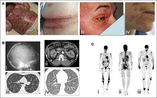 Figure 2. Examples of clinical involvement by histiocytoses. (A) Examples of cutaneous manifestations in (i) a child with multisystemic LCH, (ii) adult with intertrigo-like lesions, (ii) xanthelasma of ECD (ii), and (iii) skin manifestations of RDD. (B) Radiographic imaging and CT scans of (i) lytic skull bone lesions and (ii) pulmonary nodules and cysts in LCH, (iii) CT scan revealing typical “hairy kidney” lesions and (iv) micronodular ground-glass opacities and thickening of interlobular pulmonary septa in ECD. (C) 18F-labeled fluorodeoxyglucose (PET) imaging revealing (i) bilateral and symmetric signal in femurs, tibiae, and humeri in ECD, (ii) cutaneous multiple lesions in RDD, and (iii) signal over wrist, knees, and ankles of a patient with XD.