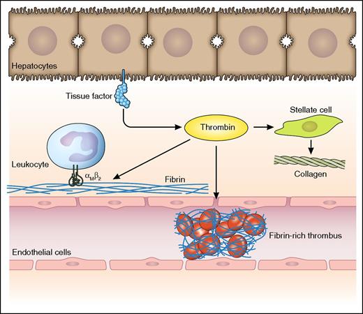 Potential consequences of intrahepatic activation of coagulation following liver injury. Liver injury results in decryption of hepatocyte (and/or biliary epithelial cell) tissue factor which results in the generation of thrombin. Thrombin potentially activates both pro- and antifibrogenic pathways: (1) It generates fibrin, which in an αMβ2-dependent manner binds leukocytes resulting in antifibrogenic effects.1 (2) It activates stellate cells resulting in enhanced collagen production.6 (3) It generates fibrin in the sinusoidal space resulting in microischemia and progression of disease.7 Professional illustration by Patrick Lane, ScEYEnce Studios.