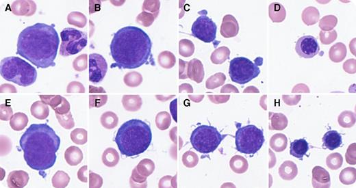 An 18-month-old girl was admitted for anemia and pallor. On admission, laboratory findings included a low hemoglobin (38 g/L), normocytic normochromic anemia pattern (mean corpuscular volume, 81.1 fL), low reticulocyte count (1.4 × 109/L), and elevated erythropoietin (6540 mIU/mL). White blood count and platelet counts were normal, with no findings suggestive of bleeding or hemolytic anemia (lactate dehydrogenase, 220 IU/L; unconjugated bilirubin, 0.3 mg/dL; haptoglobin, 93 mg/dL; and negative for direct antiglobulin test). Bone marrow (BM) examination revealed erythroblastopenia (myeloid/erythroid ratio, 8.5:1). Furthermore, most erythroblasts at various differentiation stages showed deformations, including pseudopodia (panels A-D; 38.1%), filamentous changes on cell surfaces (panels E-H; 33.3%), or both combined abnormalities (19.0%, each frequency in erythroblasts) without any giant erythroblast. Although she had no symptoms, peripheral blood and BM samples were positive for human herpesvirus–6 (HHV-6) (negative for HHV-7, cytomegalovirus, Epstein-Barr virus, and parvovirus) by polymerase chain reaction. After the second blood transfusion, her anemia resolved without recurrence, accompanied with the disappearance of HHV-6. The final diagnosis was transient erythroblastopenia of childhood (TEC). / Few studies have reported HHV-6 as a cause of TEC. In vitro analysis reported that HHV-6 suppressed erythroid-committed progenitor cells and multipotential hematopoietic colonies. However, there was little information about morphologic abnormalities in erythroblasts in TEC caused by HHV-6. These findings show distinct erythroblast deformation in the context of TEC caused by HHV-6.