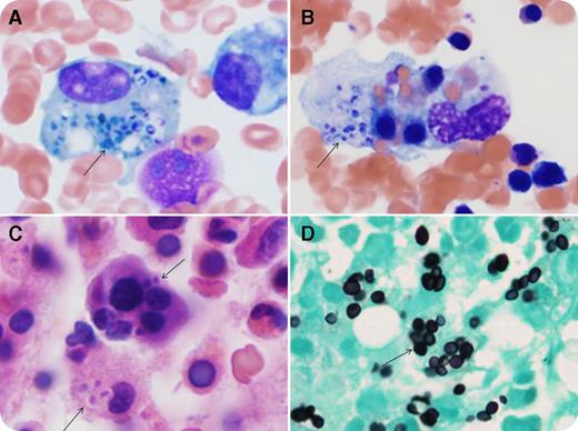 A 21-year-old man with Crohn disease and taking multiple immunosuppressive drugs presented with fevers, chills, night sweats, epistaxis, and dyspnea. He had bicytopenia (hemoglobin 9.3 g/dL, platelets 12 × 109/L, and normal leukocyte count). Biochemical studies showed markedly elevated ferritin (15 140 µg/L), decreased fibrinogen (159 mg/dL), and elevated D-dimer (2735 ng/mL) and aspartate aminotransferase (76 U/L). Computed tomography showed bilateral pulmonary micronodular infiltrates and splenomegaly. Bone marrow (BM) aspirate (Wright-Giemsa stain; panels A-B) and biopsy (hematoxylin and eosin stain; panel C) demonstrated hemophagocytosis with numerous histiocytes containing yeast forms (arrows) and hematopoietic precursors. Grocott’s methenamine silver stain highlights the yeasts (panel D). Blood, BM, and bronchoalveolar lavage cultures confirmed Histoplasma capsulatum. The patient was treated with antifungal therapy with subsequent recovery. / Hemophagocytic lymphohistiocytosis (HLH) is a systemic syndrome of histiocytic activation with hypercytokinemia. Acquired HLH is commonly associated with infections, malignancies, and collagen vascular disorders. HLH developed in this patient secondary to disseminated histoplasmosis in the setting of iatrogenic immunosuppression. HLH is associated with high mortality without appropriate treatment, and early intervention is imperative. BM examination, in conjunction with clinical and laboratory findings, is crucial for timely intervention. A diligent BM search for fungal microorganisms is also warranted in immunocompromised HLH patients because BM can sometimes be the only location to obtain the diagnosis.