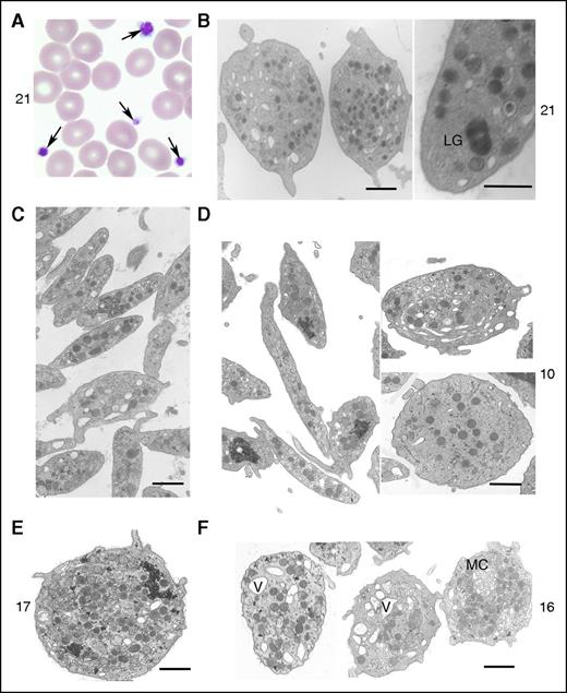 Figure 3. Effect of DIAPH1 R1213* variant on platelet morphology. Illustration of the typical platelet morphology for cases 10, 16, 17, and 21. (A) Arrows highlight platelets of different size (case 21). Original magnification, ×100; May-Grünwald-Giemsa stain. (B) Transmission electron microscopy (TEM) revealed an abnormal large granule (LG) (case 21). (C) TEM image of control platelets shows they are discoid and of regular size and have homogeneously distributed granules. All examined platelets of the patients show a heterogeneous size, shape, and distribution of α granules. (D) TEM image of a very thin elongated platelet and other platelets with a more round shape with few granules (case 10). (E) TEM image illustrates a very round platelet with many granules (case 17). (F) TEM of platelets from case 16 revealed an abnormal presence of vacuoles (V) and a membrane complex (MC). Bars represent 1 μm. The TEM images were acquired using either an EM900 (Carl Zeiss) or a JEM-1010 (JEOL) transmission electron microscope.