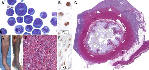 A 59-year-old man was diagnosed with HIV and Kaposi sarcoma (KS) 8 years prior to death; CD4+ count at diagnosis was 538 cells per μL. Despite antiretroviral therapy, KS required several additional therapies. More than 7 years later, the patient developed fever, rapidly progressive KS, effusions, and anasarca. Hemoglobin was 7.8 g/dL; albumin, 2.1 g/dL; and C-reactive protein, >300 mg/L. He met clinical criteria for KS-associated herpesvirus (KSHV)–associated inflammatory cytokine syndrome (KICS). Serum interleukin-6 (IL-6) was 26.2 pg/mL (1 year earlier, IL-6 was 1.4 pg/mL). Effusion cytology showed anaplastic cells with plasmacytoid cytoplasm, Reed-Sternberg–like cells, mitoses (panel A, magnification ×100), and immunopositivity for KSHV latency-associated nuclear antigen (LANA-1) (panel B, magnification ×100), diagnostic of primary effusion lymphoma (PEL). / Despite therapy, he died 2 months later. Immediately prior to death, IL-6 was 430 pg/mL. Compared with KS at PEL diagnosis (panel C), increased violaceous plaques covered extremities (panel D). At autopsy, classic KS pathologic features were noted, including atypical spindle cells in a fascicular growth pattern, extravasated erythrocytes (panel E, magnification ×40), and LANA-1 immunopositivity (panel F, magnification ×100). Diffuse lymphomatous plaques were noted on the pericardial, pleural, and peritoneal serosae, exemplified by PEL sheeting the colon (panel G, magnification ×0.4, arrowheads). Patients with well-controlled HIV remain at an elevated risk of developing KSHV-associated malignancies. PEL and progressive KS may be associated with an IL-6-related KICS.