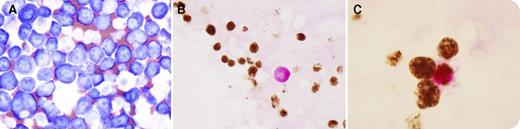 A 52-year-old man with history of AIDS, rectal Kaposi sarcoma, and multicentric Castleman disease was found to have diffuse lymphadenopathy, bilateral pleural effusions, and ascites. Cytology smears of the pleural effusion (panel A; Diff-Quik) showed numerous large atypical lymphoid cells with irregular nuclei, relatively abundant cytoplasm, and conspicuous nucleoli. A diagnosis of primary effusion lymphoma (PEL) was substantiated by cytoplasmic λ restriction by flow cytometry, expression of OCT-2 and its coactivator BOB.1 (data not shown), and positive Kaposi sarcoma herpesvirus by immunohistochemistry (nuclear punctate brown stain; panels B-C). The lymphoma cells were negative for Epstein-Barr virus. Interestingly, pancytokeratin (cytoplasmic purple stain; panels B-C) showed very rare (<1%) positive lymphoma cells (panel C), conforming that rare PEL cells show immunoreactivity for cytokeratin. / Although this is the first reported case of PEL with cytokeratin immunoreactivity among very rare lymphoma cells, positive cytokeratin expression can be encountered in ∼1.5% of lymphomas of T- and B-cell origin from the largest study of 866 lymphomas and leukemias. Although extremely rare cytokeratin expression in lymphoma cells poses less diagnostic challenge in cases of PEL, such a phenomenon should be kept in mind to avoid misdiagnosis of lymphoma as carcinoma, especially when common B-cell antigens are not expressed by lymphoma cells.