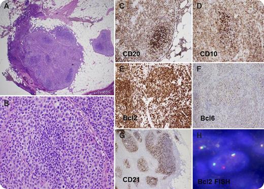 A previously healthy 62-year-old woman was taken to surgery for partial thyroidectomy for a suspected colloid nodule. A small level VI lymph node was found incidentally during surgery. The lymph node was 0.5 cm in greatest dimension. The architecture was effaced by a nodular proliferation of neoplastic cells (panel A). The follicles showed a reverse pattern with large centroblasts at the periphery of the neoplastic follicles and the small centrocytes in the center (panel B). Immunohistochemistry was performed on the tissue; the neoplastic cells were immunoreactive with CD20, CD10, bcl-2, bcl-6, and CD21 (panels C-G) and negative for CD3, CD5, and bcl-1. Fluorescent in situ hybridization with break-apart probes showed disrupted bcl-2 (panel H) and bcl-6 genes with an intact C-myc gene. / The patient was diagnosed with follicular lymphoma, grade 3B, follicular pattern. The unique morphologic feature of this case is that of a reverse variant of follicular lymphoma. The reverse (peripheral) grouping of the large cells in the follicles makes grading difficult. Positron emission tomography scan was performed on the patient and showed extensive neck, chest, and abdominal lymphadenopathy with abnormal fludeoxyglucose uptake. At diagnosis, the patient was asymptomatic and this was an incidental finding in a small lymph node.