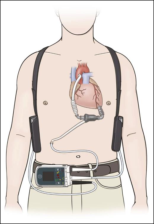 Figure 1. Schematic illustration of an implanted continuous-flow HeartMate2 LVAD (with permission from Thoratec Corporation).