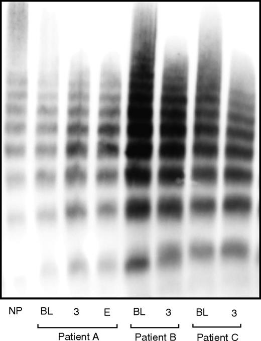 Figure 4. VWF multimer found in patients on LVAD. Examples of VWF multimer patterns found in normal plasma pooled from 32 healthy subjects and in patients on LVAD support who developed myocardial infarction (Patient A), no complication (Patient B), and severe GI bleeding (Patient C). Samples were collected before LVAD implant (BL), 3 months after implant (3), and at the time of readmission for the clinical complications (E).