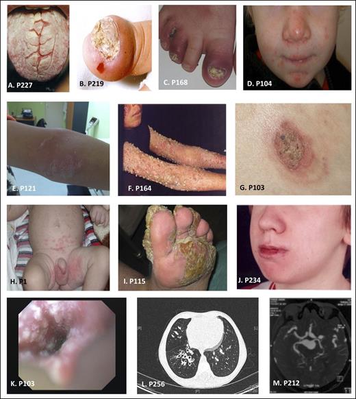 Figure 2. Photographs of patients with STAT1 GOF mutations. (A) Thrush. (B-C) Onycomycosis. (D-F) Cutaneous candidiasis. (G) Dermatophytes. (H) Cutaneous and genital candidiasis. (I) Cutaneous candidiasis. (J) Angular stomatitis. (K) Esophageal candidiasis. (L) Bronchiectasis. (M) Cerebral aneurysm. Complete phenotype of each patient is described in the supplemental Tables 1-3.