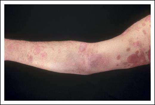 Figure 2. Patient with patches and plaques (stage IB/T2b).