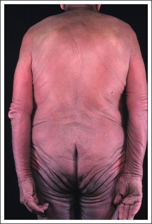 Figure 3. Patient with erythroderma (SS stage IVA1).