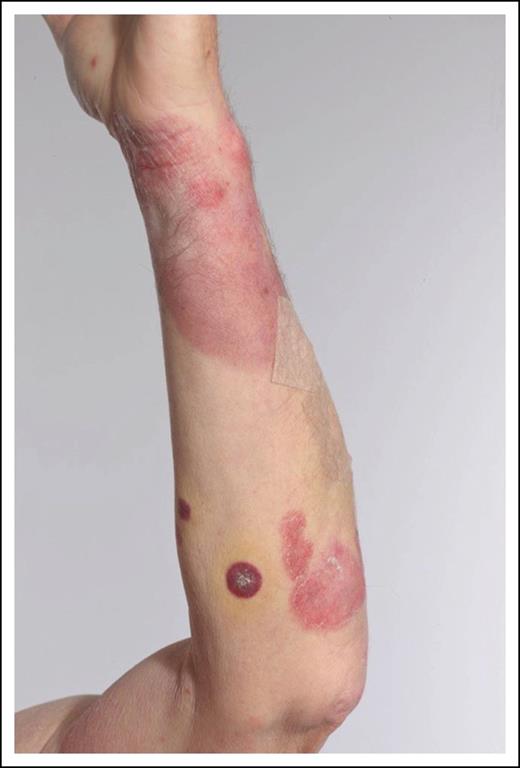 Figure 4. Patient with patches and plaques (stage IB/T2b).