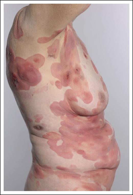 Figure 5. Patient with disease progression (stage IIB).