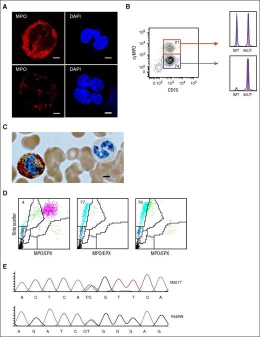Figure 2. Homozygous CALR mutations lead to MPO and EPX deficiency. Analysis of 2 peripheral blood neutrophil granulocyte populations with distinct MPO protein levels in patient 1. (A) Detection of MPO protein by confocal microscopy in neutrophil granulocytes of patient 1 with normal (top) and reduced (bottom) MPO protein. Scale bar, 5 μm. (B) Purification of the 2 neutrophil granulocyte populations according to the MPO protein level determined by flow cytometry. The numbers indicate the percentage of cells in the gate. DNA was isolated from each fraction and fragment analysis was performed. The respective histograms are shown on the right. Fragment length for CALR WT = 260 bp and for CALR type 2 mutation = 265 bp. MUT, mutated allele. (C) MPO immunocytochemistry of peripheral blood neutrophil granulocytes in patient 1. Brown precipitates represent MPO-positive granules. The ratio of MPO-positive to MPO-negative granulocytes was ∼1:2 (200 neutrophil granulocytes counted manually). Scale bar, 4 μm. (D) Peripheral blood ADVIA dot plots from a patient with MF and normal MPO activity (left), patient 2 with a homozygous CALR mutation and MPO/EPX deficiency (middle), and patient 6 with a JAK2-V617F mutation and MPO deficiency only (right). LUC (light blue), neutrophil granulocytes (purple), monocytes (green), lymphocytes (dark blue), eosinophil granulocytes (orange), and platelets/lysed red blood cells (black) are shown. MPO/EPX, MPO, and EPX-positive cells, respectively. (E) MPO DNA sequences of patient 6. Two mutations were observed in the MPO gene. The base change is denoted below the chromatogram, and the corresponding amino acid change is displayed to the right of the chromatogram. Both mutations have previously been reported to cause hereditary MPO deficiency.19