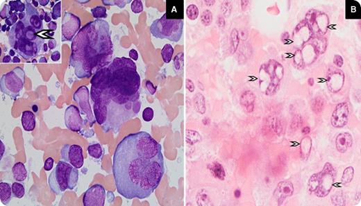 A 66-year-old woman diagnosed with breast cancer 7 years previously (treated by lumpectomy and local radiation) presented with new onset of back and rib pain. Body imaging revealed extensive pathologic rib fractures and lytic lesions involving multiple areas of the spine. Blood work showed immunoglobulin A (IgA) λ paraproteins. A bone marrow aspirate and trephine biopsy taken from the right iliac crest showed hypercellularity, with almost 80% of marrow involvement by highly pleomorphic cells. These cells were multilobated or multinucleated with abundant gray-blue cytoplasm (panels A-B). Some of the cells contained Dutcher bodies (panels A-B, arrows). Immunohistochemistry showed the multinucleated cells were positive for CD138, and negative for CD20, CD3, and pan-keratin marker (AE1/AE3). Cytogenetic analysis revealed a complex karyotype. Interphase fluorescence in situ hybridization studies demonstrated a t(4;14) (p16;q32)–FGFR3/IGH translocation in ∼80% of the cells. Overall findings were consistent with plasma cell myeloma with anaplastic features. / Anaplastic myeloma is a rare aggressive variant of myeloma. The pleomorphic multinucleated morphology can mimic multinucleated carcinomas. The previous history of breast carcinoma also made diagnosis more challenging in this case. The other distinctive feature was the presence of Dutcher bodies, which are periodic acid-Schiff–positive, diastase-resistant nuclear pseudo-inclusions. They are associated with lymphoplasmacytic lymphoma and plasma cell neoplasms and appear more frequently in t(4;14) myeloma with IgA isotype.