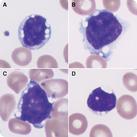 A 65-year-old man undergoing workup for transverse myelitis was found to have lymphadenopathy and splenomegaly. His complete blood count results were significant for anemia and mild thrombocytopenia. His white blood cell count was 6.1 × 109/L, with a normal absolute lymphocyte count of 1.8 × 109/L. The peripheral smear review contained mature-appearing lymphocytes with sharp vacuoles (panels A-D), accounting for 4% of cells by manual differential. Flow cytometry revealed 3% of events to be monoclonal B cells that were positive for bright CD20, CD5, and bright κ light-chain; they were negative for CD10, CD23, and CD200. A bone marrow biopsy showed trilineage hematopoiesis and small nonparatrabecular lymphoid aggregates. Flow cytometry found a similar population to that in the peripheral blood (4% of cellularity). Stimulated karyotype showed a complex karyotype including t(11;14)(q13;q32). Characteristic translocations of Burkitt lymphoma/leukemia were not present. Overall, these findings are diagnostic of mantle cell lymphoma. / Discrete vacuoles in lymphocytes should prompt further investigation. They may be seen in a variety of entities, including lysosomal storage diseases and neoplastic disorders. In this case, the vacuoles were a key finding that raised suspicion for an underlying lymphoproliferative disorder. Only through incorporation of clinical findings, morphology, and ancillary testing was the diagnosis reached in this subtle case of mantle cell lymphoma.