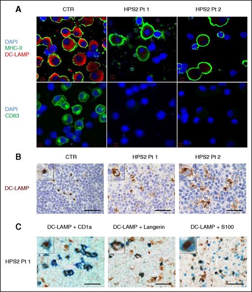 Figure 1. Altered expression of maturation markers in HPS2 DCs. (A) moDCs from HPS2 patients and control were induced to mature by culture with LPS for 24 hours, seeded on glass, and permeabilized with methanol. DCs were stained with moAbs against DC-LAMP (red) or HLA-DR (green) (top panels), and with anti-CD83 (green) and DAPI (blue) (bottom panels). Images were acquired using a confocal microscope (LSM 510 META; Carl Zeiss Inc.) with a ×100/1.3 oil objective. Images were acquired sequentially using separate laser excitations to avoid crosstalk between the fluorophore signals. (B-C) IHC on formalin-fixed paraffin-embedded sections obtained from lymph nodes of Pt1, Pt2, and control. In the lymph nodes from HPS2-patients, DC-LAMP reactivity is diffused in the cytoplasm, whereas in control, DC-LAMP reactivity is limited to the classical paranuclear dot (B, inserts). By double IHC (C), DC-LAMP+ cells (brown) coexpress CD1a (41% of DC-LAMP+ cells), Langerin (45%), and S100 protein (62%) (blue). CTR, control; DAPI, 4′,6-diamidino-2-phenylindole; MHC, major histocompatibility complex; Pt, patient.