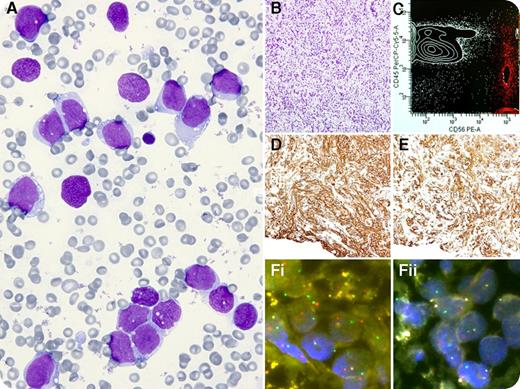 A 16-year-old girl was admitted for fever and severe malaise. Multiple ecchymoses and asymmetry of labia majora were observed. The hemogram showed a white blood cell count of 8.7 × 109/L, hemoglobin 82 g/L, and platelets 33 × 109/L. A blood smear showed 3% blasts. Fibrinogen was 100 mg/dL. A bone marrow aspirate showed 83% immature noncohesive blast-like cells (panels A-B) negative for myeloperoxidase. Marked bleeding at the marrow and venipuncture sites occurred. Flow cytometry showed CD45– and CD56++ (panel C, red dots). No metaphases were obtained. A provisional diagnosis of acute undifferentiated leukemia was made, and she received a 3 + 7 idarubicin-cytarabine regimen. Twenty days later, a biopsy of the vulva was performed. Positive immunostains for actin (panel D) and desmin (panel E), as well as MyoD1, myogenin, vimentin, Alcian blue, and CD56 were observed. Fluorescent in situ hybridization analysis revealed t(2;13)(q35;q14) (panels Fi-ii). A final diagnosis of rhabdomyosarcoma (alveolar subtype) was established. The patient has received four cycles of a vincristine, actinomycin D, and cyclophosphamide schedule so far. / Leukemic phase and bone marrow metastases can be an uncommon presentation of rhabdomyosarcoma as well as other neural/neuroendocrine tumors, small cell carcinoma, and Ewing sarcoma. Those diagnoses should be pursued when atypical or inconsistent data are obtained after a bone marrow aspirate.