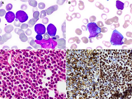 A 51-year-old man presented with fever, weakness, generalized body rash, and splenomegaly. Complete blood counts showed hemoglobin 12.1 g/dL, hematocrit 35.5%, mean corpuscular volume 81.8 fL, mean corpuscular hemoglobin 27.9 pg, white blood cells 76.9 × 109/L, absolute neutrophil count 5.5 × 109/L, and platelets 21 × 109/L. Peripheral blood film displayed 70% atypical lymphoid cells with basophilic cytoplasm having vacuolations and blast cells (panels A-B). Bone marrow aspirate had heterogeneous population of small to medium sized blast cells. Bone biopsy was effaced with predominant blast cells (panel C) expressing CD20 and CD10, with MYC/B-cell lymphoma 2 (BCL2) protein coexpression (panels D-E), and 100% Ki-67 index and negative for terminal deoxynucleotidyl transferase (Tdt) and Bcl6. Immunophenotyping showed reactivity to HLA-DR, CD45, CD19, CD20, CD22, and cCD79a and κ light chain restriction but was negative for Tdt. T8:14 was not detected by fluorescence in situ hybridization. A diagnosis of BCL unclassifiable (BCLU) with features intermediate between Burkitt lymphoma (BL) and diffuse large BCL (DLBCL) was made. The patient was started on chemotherapy but his disease was unresponsive and progressive. / In 2008, the World Health Organization defined BCLU as a distinct entity with overlapping histologic and molecular features of BL and DLBCL. Coexpression of MYC/BCL2 or “double expression” is associated with inferior survival.