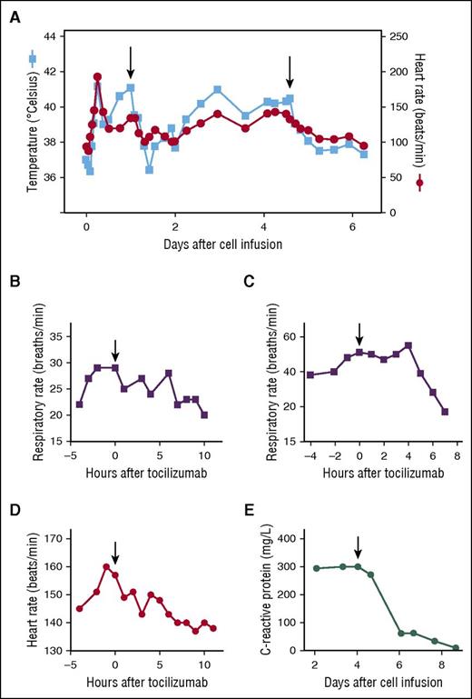 Figure 2. Response to tocilizumab in 2 patients. Patient 1 is a 54-year-old male who received T cells transduced with a CAR targeting B-cell maturation antigen. He experienced CRS starting 4 hours following T-cell infusion, with development of fevers, tachycardia, tachypnea, hypoxia, and hypotension requiring vasopressors. (A) Patient 1 received tocilizumab 25 hours after his cell infusion, which was followed by a transient decrease in temperature and heart rate. He experienced worsening CRS and received a second dose of tocilizumab on day 5 following cell infusion, which was followed by a sustained decrease in temperature and heart rate. (B) The respiratory rate of patient 1 decreased following his first dose of tocilizumab, and intubation was avoided. (C) Patient 2 is a 20-year-old woman with a history of ALL with a past history of a matched-related donor SCT. She received donor-derived T cells transduced with a CAR targeting CD19 for progressive ALL after transplant. She experienced CRS toxicity with fevers, tachycardia, tachypnea, hypoxia, left ventricular systolic dysfunction, prolonged activated PTT, and increased creatine kinase. She received tocilizumab on day 4 following CAR T-cell infusion. Her respiratory rate decreased following tocilizumab, and intubation was avoided. (D) The heart rate of patient 2 decreased following tocilizumab. (E) Following tocilizumab, CRP in patient 2 decreased over a period of days. Professional illustration by Patrick Lane, ScEYEnce Studios.