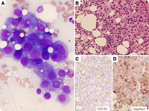 An 80-year-old man with back pain, a rib fracture, and multiple bone lytic lesions was diagnosed with multiple myeloma (MM) by bone marrow (BM) biopsy and transferred to our hospital. The BM aspirate showed many clusters of atypical cells resembling immature neoplastic plasma cells (panel A). The BM biopsy showed sheets of tumor cells (panel B). His serum immunoglobulin and free κ/λ ratio were normal. His serum alpha-fetal protein (AFP) was 16 038 ng/mL, and carbohydrate antigen 19-9 level was 207.4 U/mL. Positron emission tomography-computed tomography and ultrasound did not detect any mass in the liver or other abdominal organs. There were multiple bone lytic lesions at the scalp, rib, vertebra, and femur, with soft tissue infiltration and a large paraspinal mass (7.6 × 3.8 cm) at the left L2 level. / By immunohistochemistry, the tumor was positive for pan-cytokeratin (CK), arginase 1, HepPar1, and CD138 (panels C and D) and negative for κ and λ, supporting hepatocellular carcinoma (HCC). A positive CD138 staining of the tumor cells likely contributed to the initial diagnosis of MM. Tumor cells were negative for AFP despite increased serum AFP. The lack of CK19, OCT3/4, and GATA3 ruled out a yolk sac tumor, which is a differential diagnosis for high serum AFP levels. HCC can develop in ectopic liver tissue without a liver mass. The large paraspinal mass may be the most likely primary site. Core biopsy confirmed it as a moderately differentiated HCC.