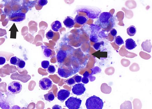 A 33-year-old man with history of sickle cell disease who receives regularly scheduled exchange transfusion and transfusions was found to be neutropenic. His absolute neutrophil count (ANC) initially recovered after administration of filgrastim; however, his ANC fell below 1000/mm3 1 week later. A bone marrow biopsy was performed to determine the cause of the patient’s neutropenia. The bone marrow demonstrated increased erythroid precursors with megaloblastic changes, consistent with sickle cell anemia–associated marrow findings. Additionally, there was prominent hemophagocytosis, characterized by numerous bland-appearing histiocytes containing phagocytosed erythrocytes within the cytoplasm (arrows). / Hemophagocytosis in the context of hemophagocytic lymphohistiocytosis has been reported in association with sickle cell disease. Hemophagocytosis has also been described as a reactive process associated with blood product transfusion, viral infection, or bacterial sepsis. Follow-up with the patient revealed no clinical or laboratory evidence to suggest infection or inflammation. Although the significance and etiology of the hemophagocytosis seen in this patient’s marrow is unclear, it may be associated with recent transfusions he received prior to marrow collection. Additionally, it is possible this phenomenon was observed as a response to sickling. Ultimately, the patient’s ANC recovered after discontinuation of nonsteroidal anti-inflammatory drugs and hydroxyurea.