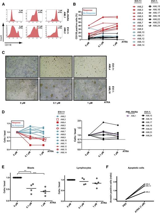 Figure 1. ATRA induces differentiation in EVI-1–positive AML. (A) Flow cytometric analysis of CD11b expression in PML-RARA mutated (upper) and EVI-1–positive (lower) AML cases incubated with or without ATRA for 7 days. (B) Quantification of CD11b expression in 13 EVI-1–positive AML cases (red lines, responders; blue lines, nonresponders) and 7 EVI-1–negative AML cases (black lines). (C) Morphologic examination (×10 0.25 objective) of cells from an EVI-1–positive AML case (upper) and an EVI-1–negative AML case (lower) before and after treatment with ATRA for 14 days. (D) Quantification (by flow cytometry) of cell viability (number of cells per number of beads) in AML cases incubated with or without ATRA for 7 days. Relative number of cells in EVI-1–positive AML cases (left: red lines, responders; blue lines, nonresponders), in EVI-1–negative cases (right, black lines) and in a PML-RARA–mutated AML case (right, purple line). (E) Number of myeloid blasts (CD45dim/CD33+) and lymphocytes (CD45high/SSClow) relative to the number of measured beads in EVI-1–positive AML cases that showed a reduced number of total cells upon ATRA incubation (responders, D, left, 5/13 cases). Incubation of AML3 with 0.1 µM ATRA was not done in this experiment. (F) Flow cytometric analysis of AML cells treated with ATRA for 7 days and labeled with annexin-V and 7-AAD. Shown is the number of annexin-V–positive cells relative to the number of beads.